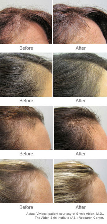 Viviscal Ingredients Reviews On Before And After Results