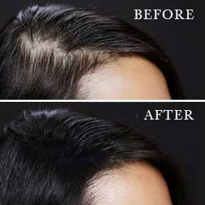 via http://www.msfullhair.com/moresolutions/microneedleroller