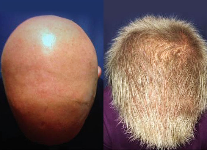 FDAApproved Drug Cured Patients with Alopecia Areata