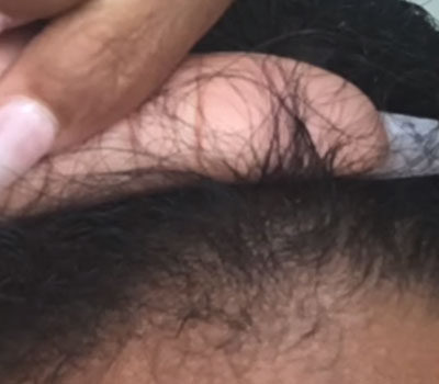 bald stop treatment home remedy