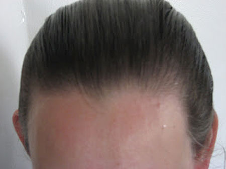 regrow hair on receding hairline