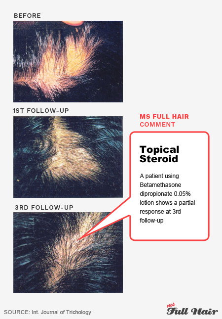 what"s the best alopecia areata treatment?