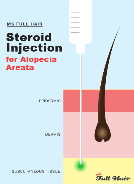 what"s the best alopecia areata treatment?