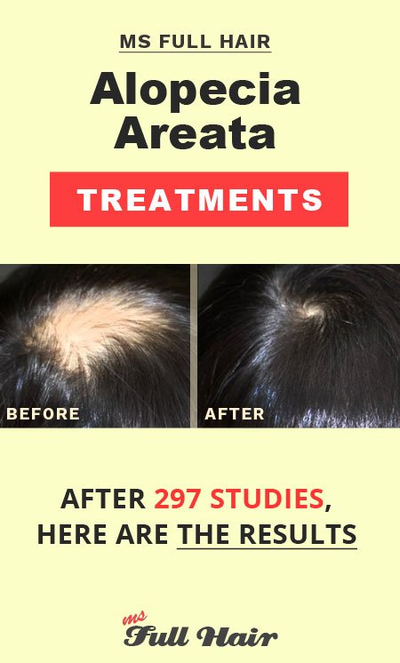 what"s the best alopecia areata treatment?