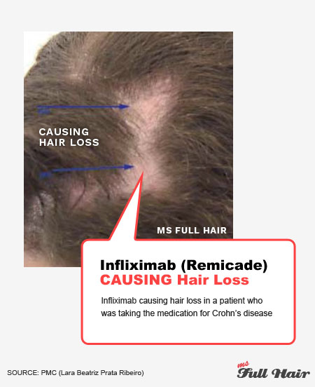 infliximab remicade induced hair loss anti tnf inhibitors
