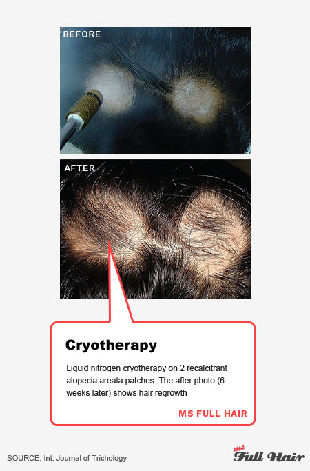 alopeciaareata,alopecia what"s the best alopecia areata treatment?