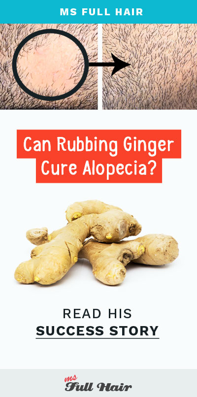 Can Ginger Cure Alopecia Hair Loss This Guy Says Yes