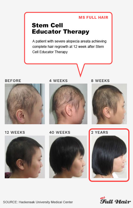 what"s the best alopecia areata treatment?