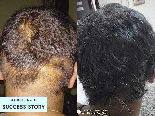 Alopecia Areata Hair Regrowth Success Story